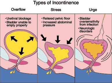 BLADDER CONTROL / INCONTINENCE - Dayan Physiotherapy and Pelvic
