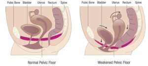 pelvic floor dysfunction