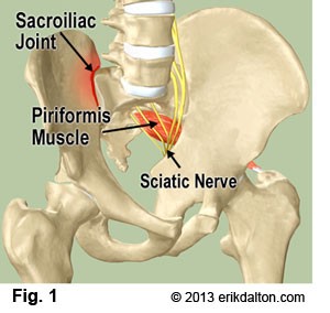 Sacro iliac joint pain Victoria BC